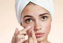 AKNE – 8 TOP prehranskih dodatkov, ki pomagajo odpraviti MOZOLJE