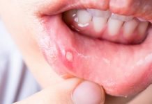 AFTE – Prehranski dodatki, ki so priporočljivi, če se vam pojavijo afte