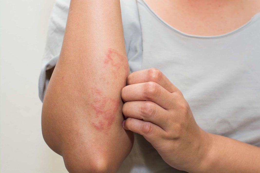 stopični dermatitis