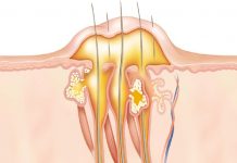 ABSCESI IN TURI NA KOŽI – 8 TOP prehranskih dodatkov, ki zdravijo ABCESE in TURE