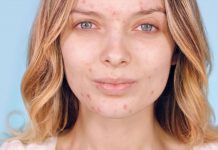 Akne – Hrana, ki zdravi akne in hrana, ki jih povzroča