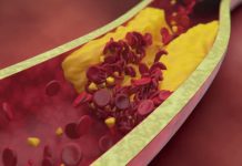 ATEROSKLEROZA ALI POAPNENJE ŽIL – Prehranski dodatki, ki pomagajo obvladati aterosklerozo