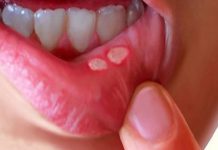 AFTE – S pravilno izbiro hrane lahko skrajšamo čas celjenja razjed v ustni votlini