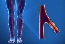 Arterijska bolezen nog – Periferna arterijska bolezen in prehrana