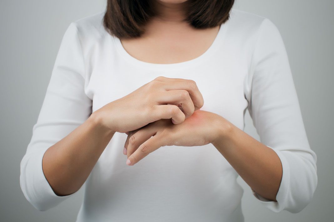 Atopični dermatitis