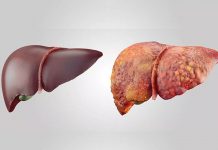 Jetrna ciroza – Hrana, ki skrbi za naša jetra