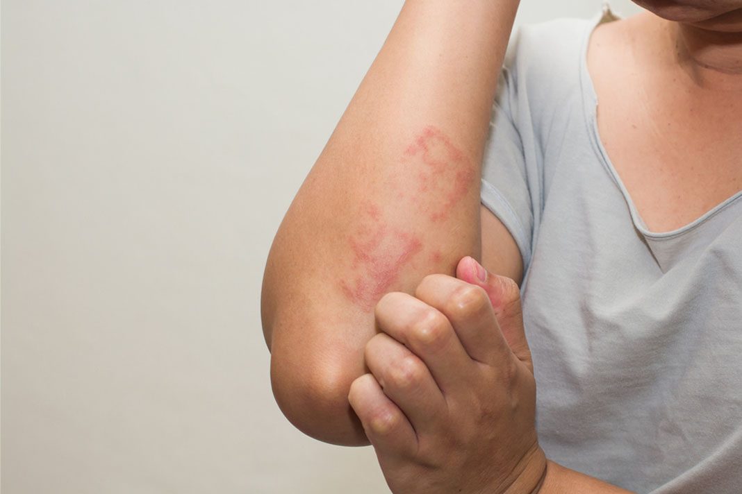 Dermatitis