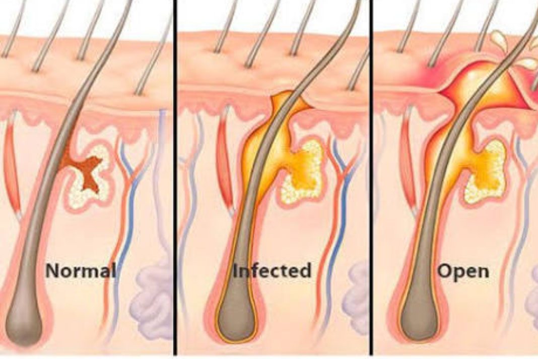 FOLIKULITIS