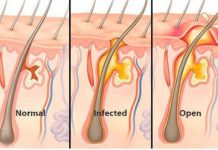 FOLIKULITIS – Prehranski dodatki, ki pomagajo preprečevati vnetje lasnega mešička