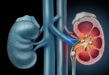 LEDVIČNI KAMNI – Prehranski dodatki, ki preprečujejo nastanek ledvičnih kamnov