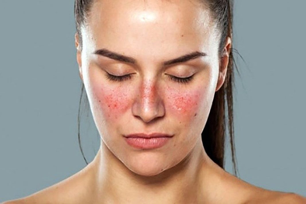 Lupus