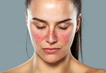 SISTEMSKI ERITEMATOZNI LUPUS – 6 TOP Prehranskih dodatkov, ki lajšajo LUPUS