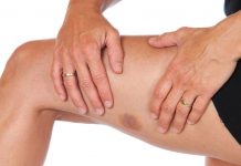 MODRICE – Prehrnska dopolnila, ki odpravljajo modrice