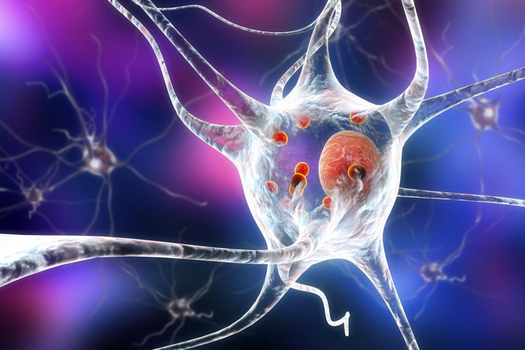 Parkinsonova bolezen