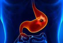 RAZJEDA ŽELODCA ALI DVANAJSTNIKA – Prehranski dodatki, ki pomagajo pri razjedi želodca ali dvanajstnika