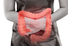 Ulcerativni kolitis – Pri vnetju v črevesu pomaga pravilna prehrana