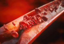 Ateroskleroza – Tihi sovražnik, ki ga lahko premagamo s pravilno dieto