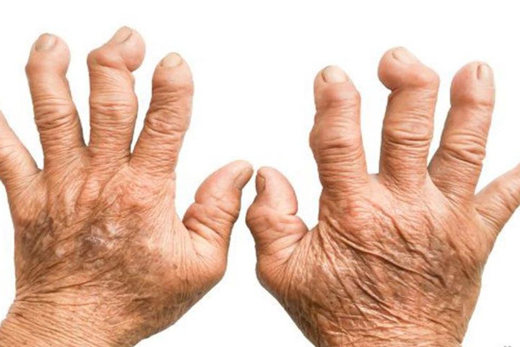 artritis