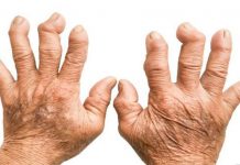 Revmatoidni artritis – Prehranjevanje za zdrave sklepe