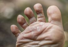 ATLETSKO STOPALO – Odpravite glivično okužbo stopal s prehranskimi dopolnili