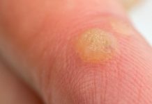 VIRUSNE BRADAVICE – Kako s prehranskimi dopolnili nad virusne bradevice