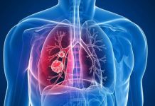 Bronhitis – Prehranska podpora pri prebolevanju bronhitisa/Hrana bolnika z bronhitisom