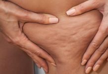 CELULIT – Tudi prehranski dodatki lahko pomagajo v boju s celulitom