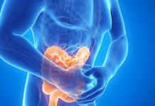 Divertikli – Spremembe v prebavnem traktu, ki zahtevajo prilagajanje prehrane