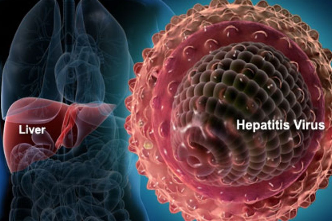 hepatitis