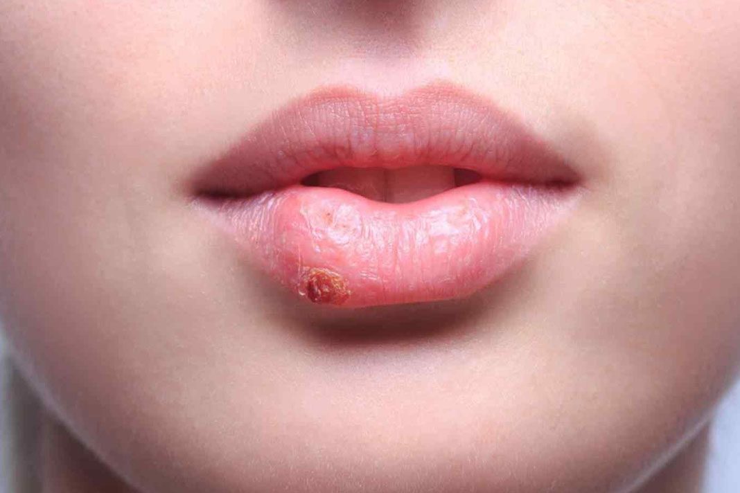 herpes