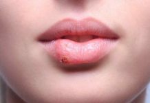 Herpes – Učinkovite akupresurne točke, ki odpravljajo herpes