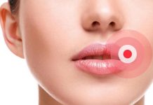 HERPES – Prehranska dopolnila, ki preprečujejo oz. zdravijo herpes