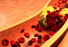 Holesterol – Kadar se ravnotežje maščob poruši, izberite pravo dieto