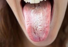 Kandida (Candida) – Okužbe s kandido, kako si pomagati s prehrano