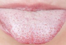 KRONIČNA KANDIDOZA – Kako si pri kandidozi pomagati s prehranskimi dopolnili