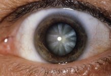 KATARAKTA – Prehranski dodatki, ki se priporočajo pri katarakti