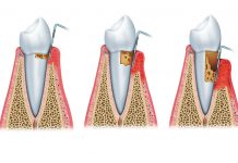 PARODONTALNA BOLEZEN – Prehranska dopolnila, ki pripomorejo k zdravi ustni votlini