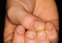 Pomanjkanje biotina – Redko stanje, ki zahteva tudi prilagoditev prehrane