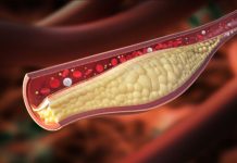 POVIŠAN HOLESTEROL – 8 TOP prehranskih dodatkov, ki odpravljajo POVIŠAN HOLESTEROL