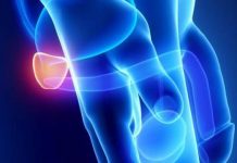 Bolezni prostate – Povečanje prostate in pomoč v prehrani