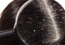 Prhljaj – Hrana, ki prežene prhljaj in hrana, ki stanje poslabša