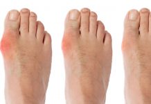 Putika / jetika / protin – Nabiranje sečne kisline v sklepih lahko zmanjšamo s pravilno prehrano