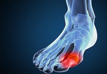 PROTIN ALI PUTIKA – Prehranski dodatki, ki so priporočljivi pri spopadanju s protinom