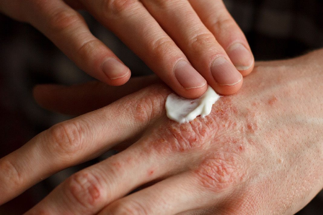 psoriasis