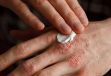 Luskavica (Psoriaza) – Dieta z manj glutena in druga živila, ki pomagajo pri luskavici