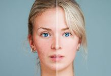 ROZACEA ALI RDEČICA – 10 TOP Prehranskih dodatkov, ki pomagajo osebam z ROZACEO ALI RDEČICO