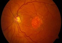 DEGENERACIJA RUMENE PEGE – 7 TOP prehranskih dopolnil, ki preprečujejo DEGENERACIJO RUMENE PEGE