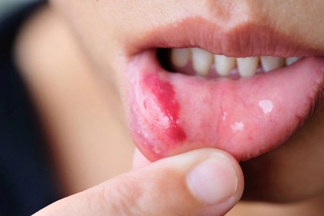 stomatitis