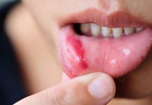 Stomatitis – Vnetje v ustni votlini – kako pomagati s pravilno prehrano