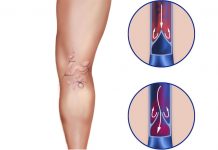 Varice – razširjene vene – Kaj lahko za zdravje ven naredimo s prehrano?